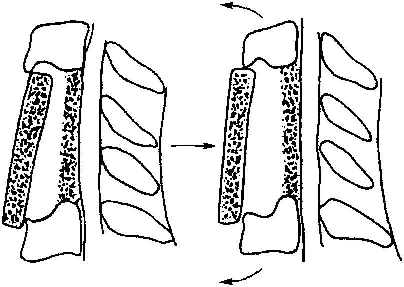 第六節(jié) 頸椎前路手術(shù)并發(fā)癥及處理對(duì)策